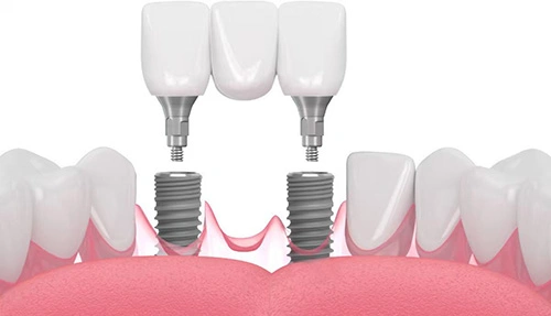 Puente sobre implantes